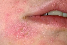 Alerjik Egzama Belirtileri ve Tedavisi