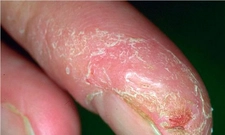 Atopik Egzama Belirtileri ve Tedavisi