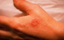 Egzama Tedavisi Egzama Nasıl Tedavi Edilir