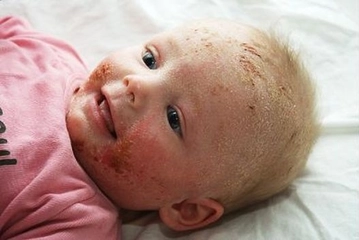Bebeklerde Egzama Belirtileri ve Tedavisi