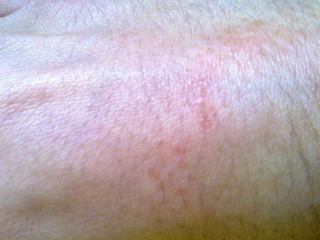 Egzama Kremi Egzama Tedavisinde Kullanılan Kremler