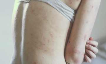 Sulu Egzama Belirtileri ve Tedavisi