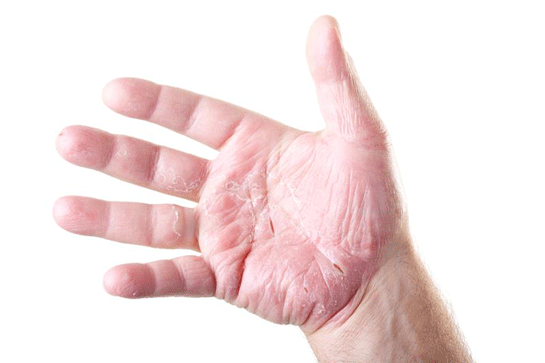 Atopik Dermatit Egzama Belirtileri ve Tedavisi